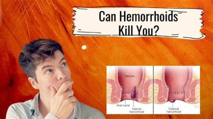 Are external hemorrhoids dangerous?