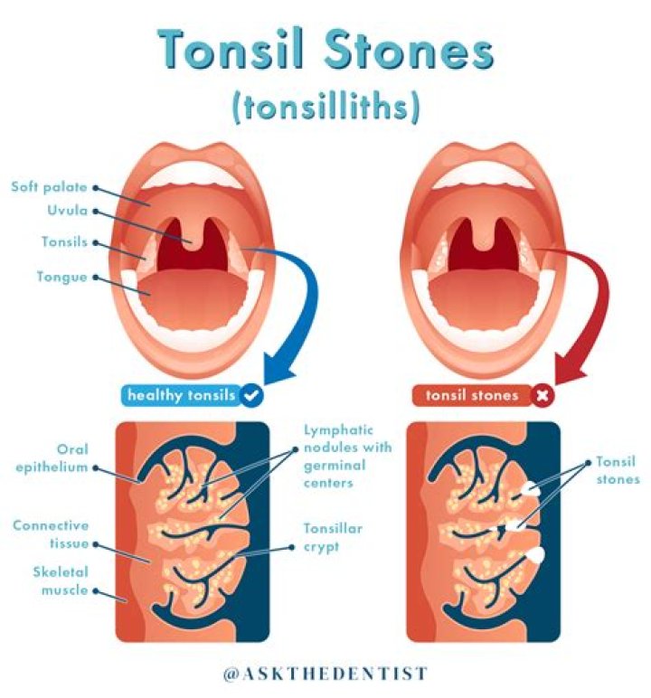 Are tonsil stones common?