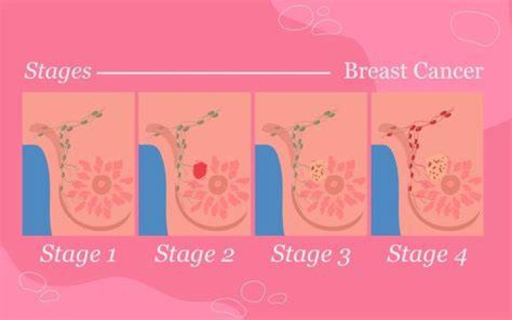 Are we overtreating breast cancer?