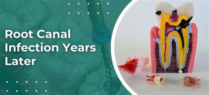 Can a root canal get infected years later?