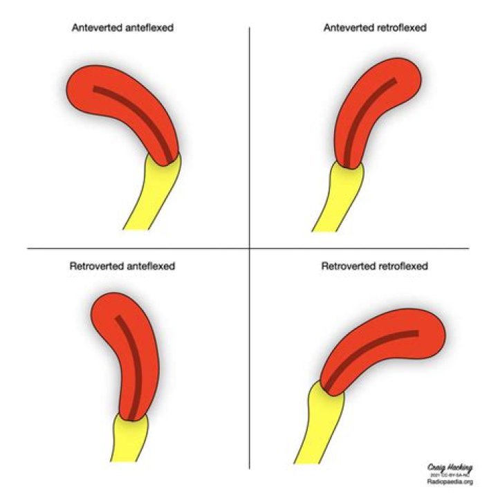 Can a uterus go from anteverted to retroverted?