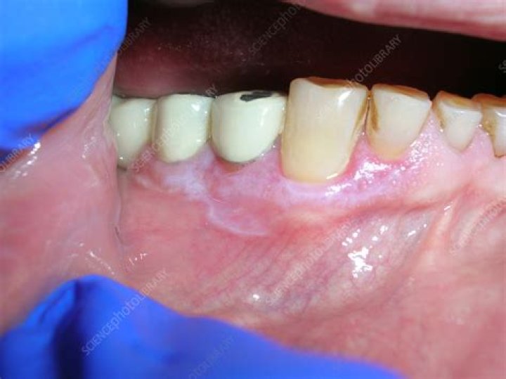 Can amalgam fillings cause lichen planus?