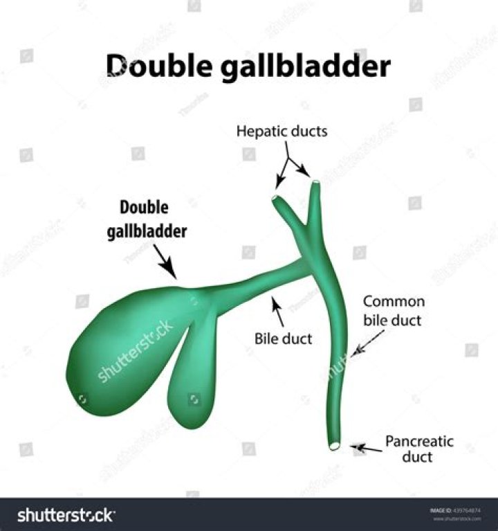 Can you have 2 gallbladders?