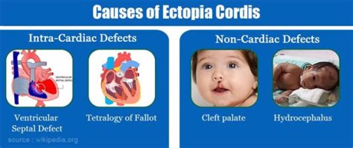 Can you live with ectopia cordis?