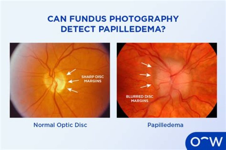 Do i have papilledema?