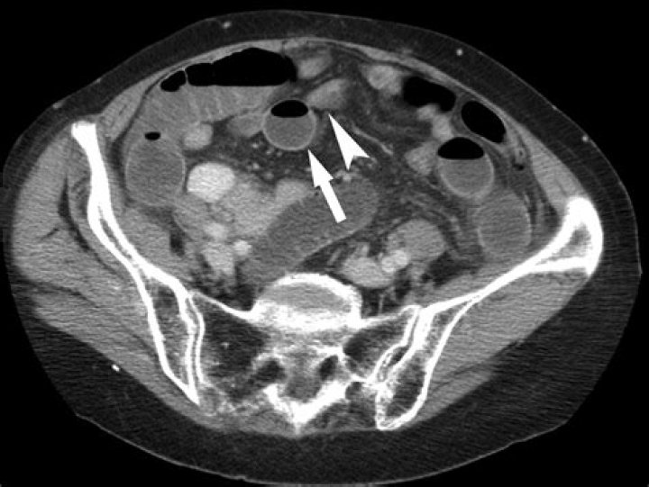 Does bowel obstruction show up on ct scan?