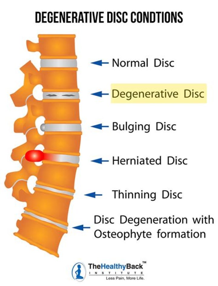 Does degenerative disc disease get worse?
