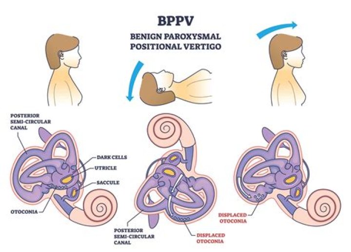 Does idiopathic vestibular disease come back?