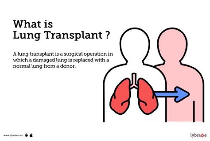 Does insurance cover lung transplants?