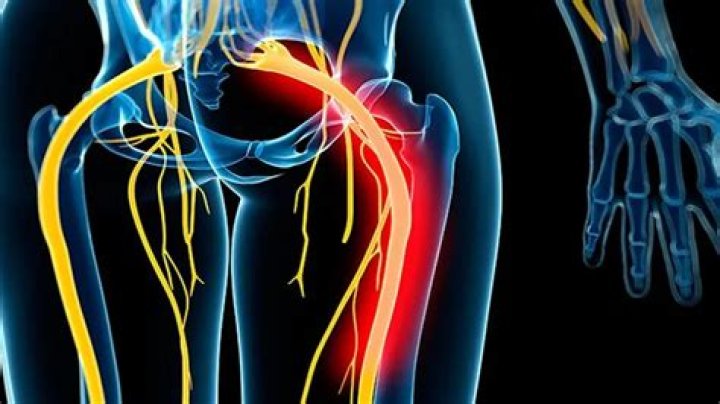 Does stenosis cause sciatica?