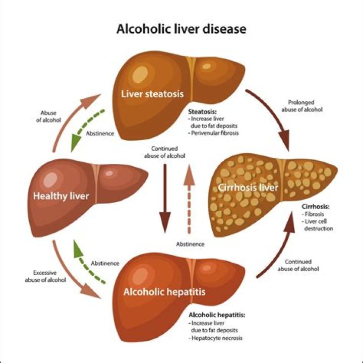 How alcohol causes liver damage?