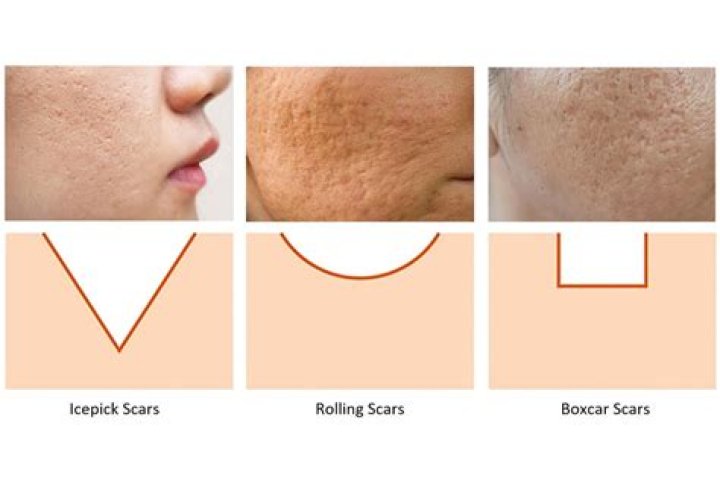How do boxcar scars form?