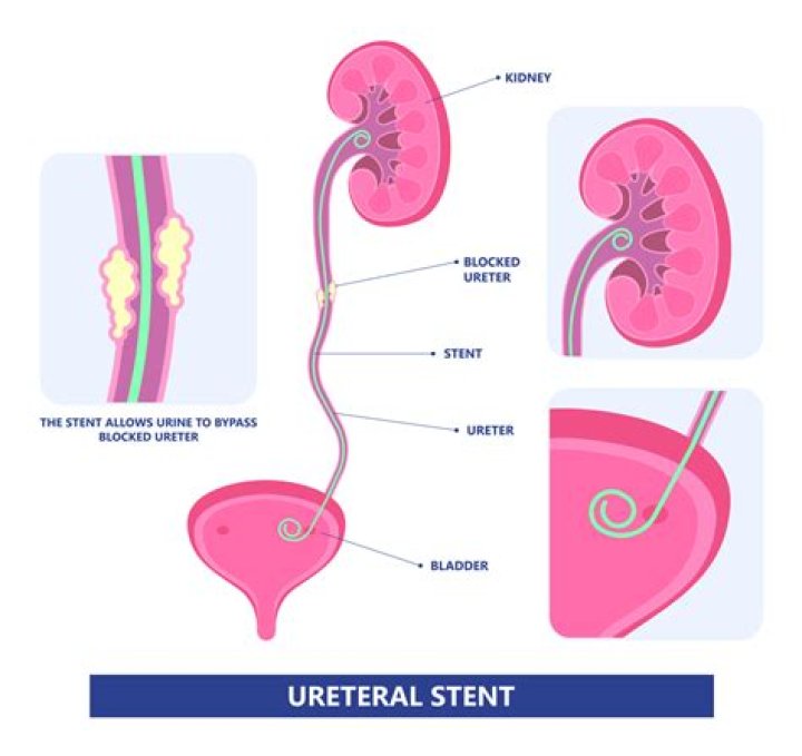 How long ureteral stent?