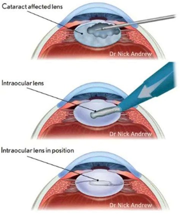 How to code capsulectomy?