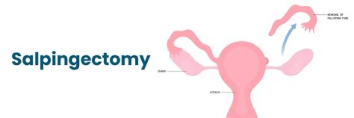 How to code salpingostomy?