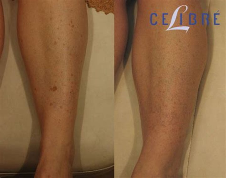 How to remove brown sun spots from legs?