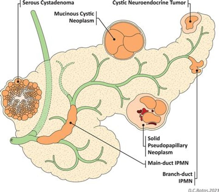 In cystic fibrosis of the pancreas?