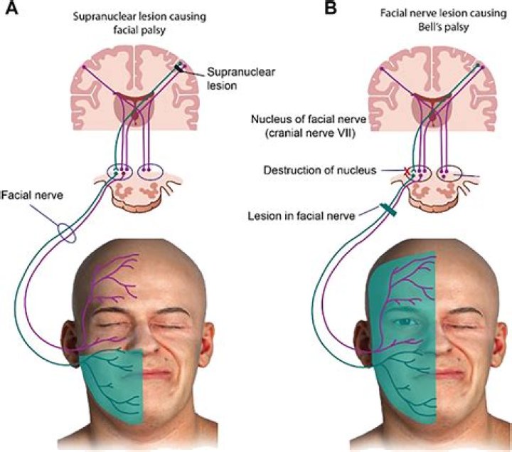 Is bell's palsy upper motor neuron?