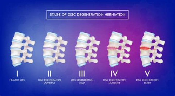 Is disc desiccation normal?
