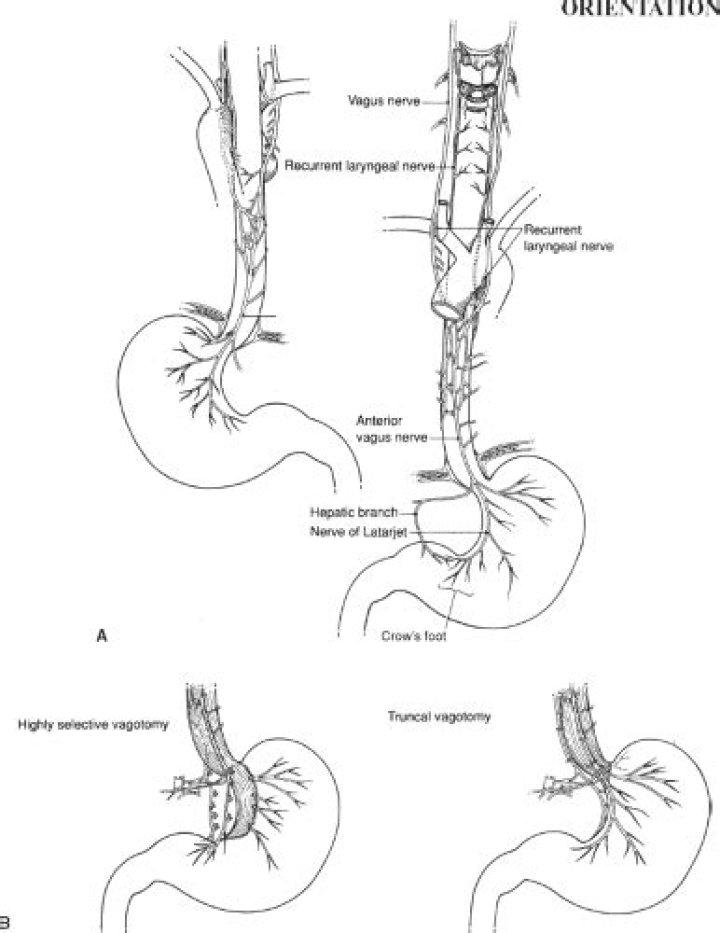 Is highly selective vagotomy?