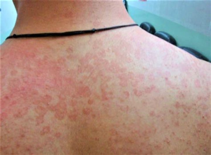 Is tinea versicolour itchy?