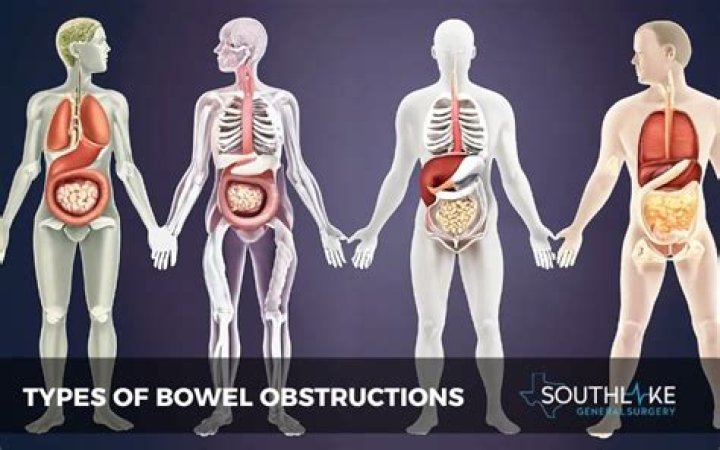 What are the signs of a bowel obstruction?