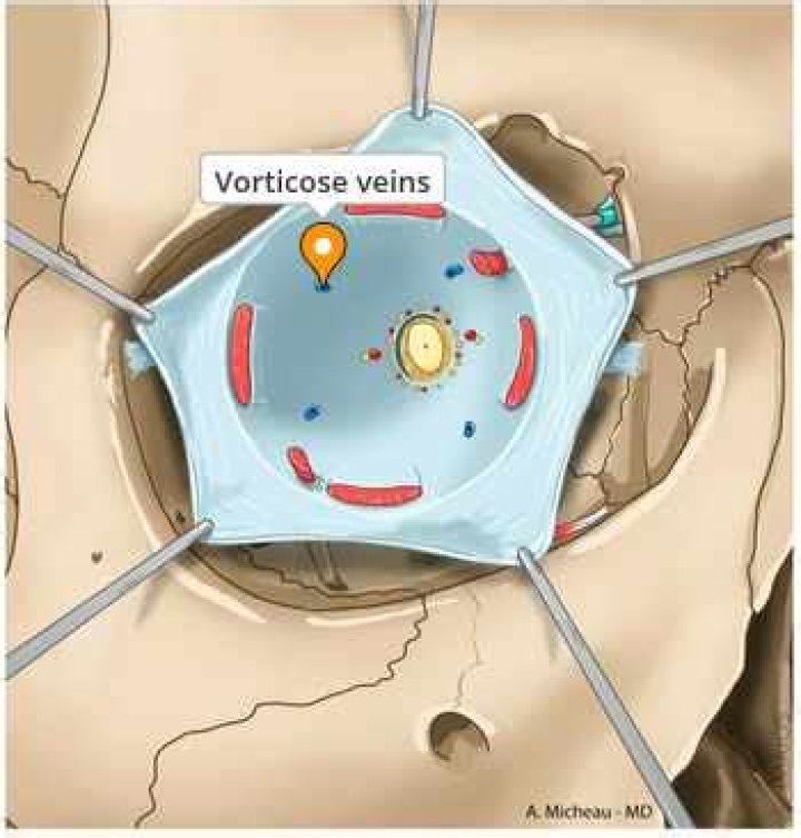 What are vorticose veins?