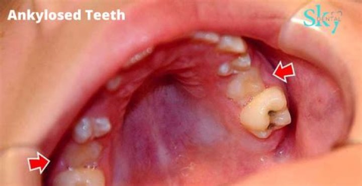 What causes ankylosed teeth?