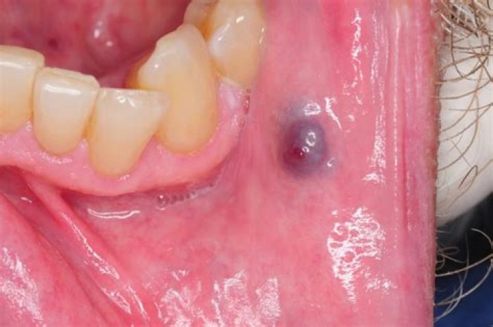 What causes blood filled bump in mouth?