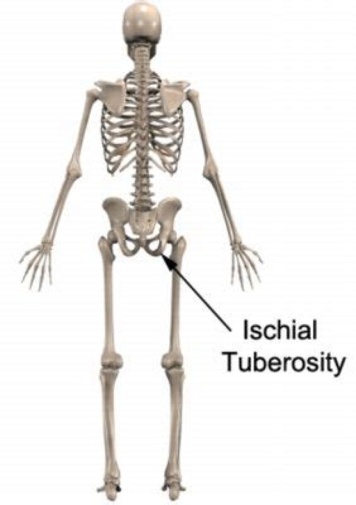 What causes ischiogluteal bursitis?
