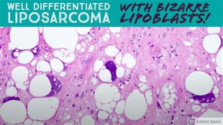What does lipoblastoma mean?