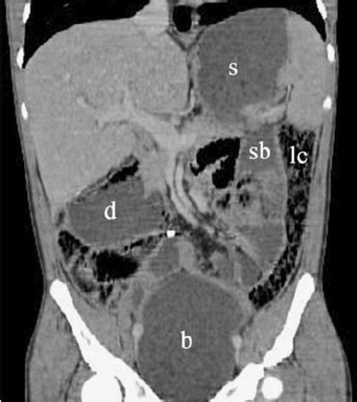 What is cipo disease?