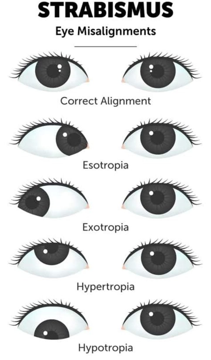 What is eye misalignment?
