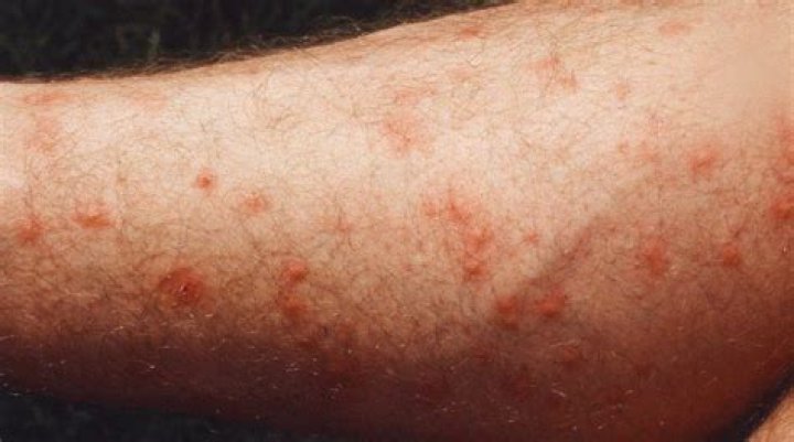 What to put on itchy midge bites?