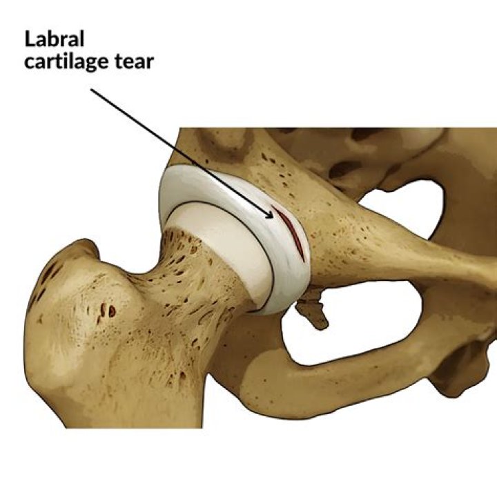 Whats a labrum tear?