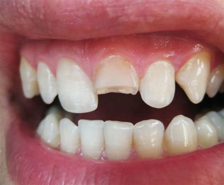 Whats an eye tooth?