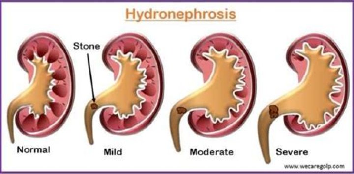 Where is hydronephrosis found?
