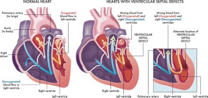 Who has ventricular septal defect?