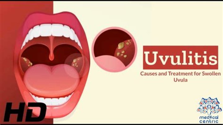 Why do i get uvulitis?