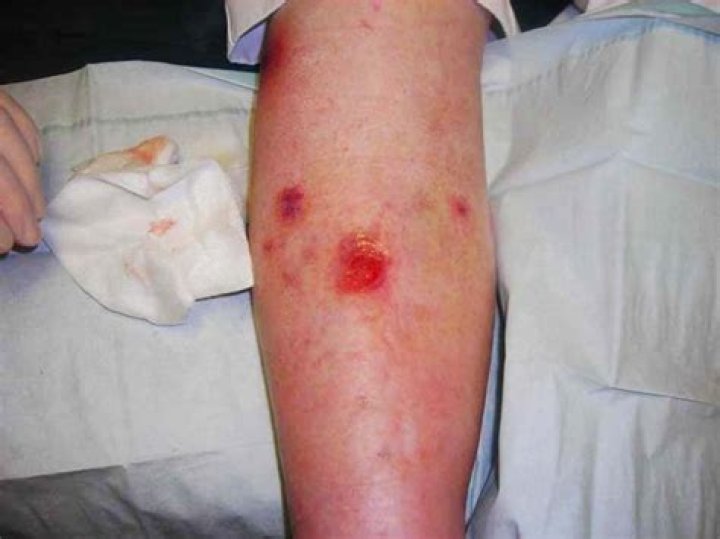 Why do legs become ulcerated?