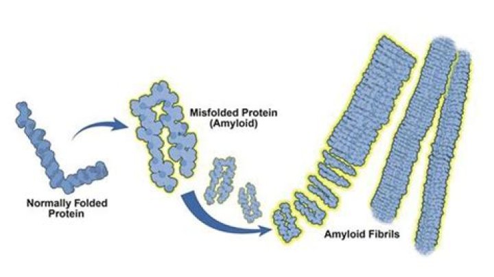 Why is amyloidosis a problem?