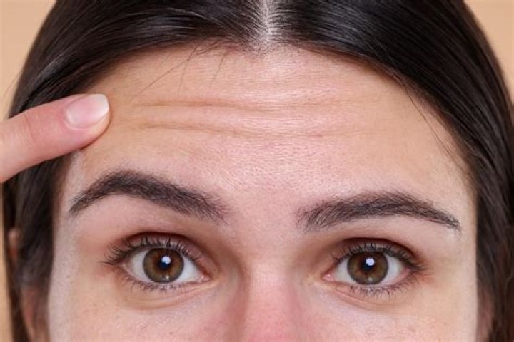 Why wrinkles on forehead?