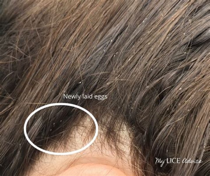 Will a flat iron kill lice eggs?