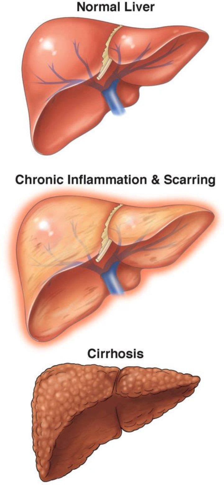Will cirrhosis kill you?