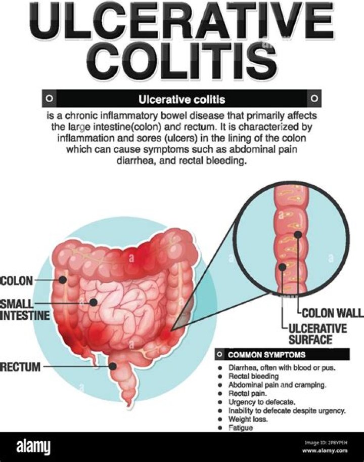 Will my child get ulcerative colitis?